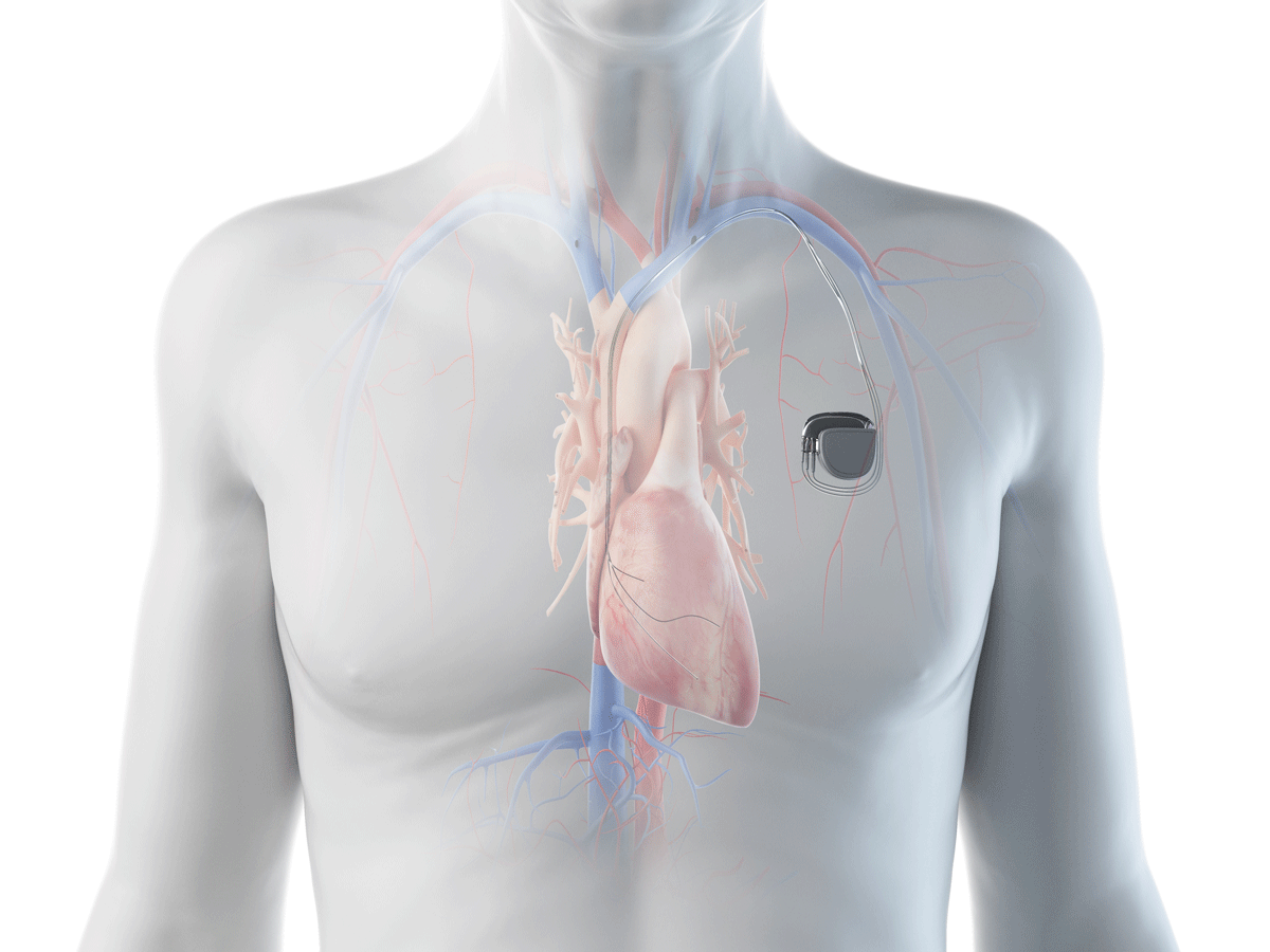 3D rendered illustration of a man with a pacemaker. Adobe stock.